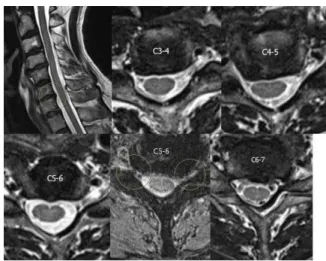 Fig. 4. C-spine MRI of case 3