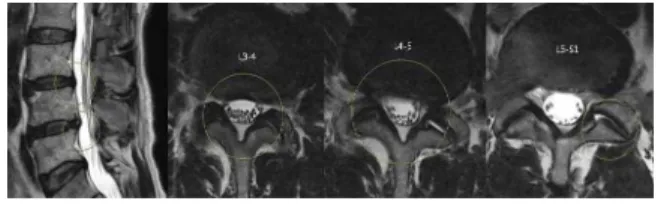 Fig. 5. L-spine MRI of case 4