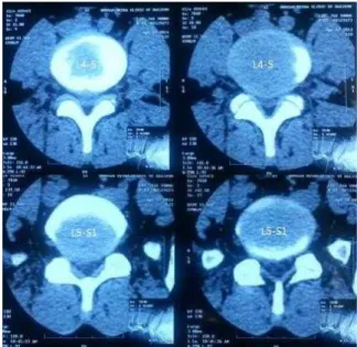 Fig. 6. L-spine CT of case 5