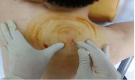 Fig. 2. Point 2 of acupotomy