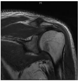 Fig. 8. Shoulder MRI, T1 weighted Image of case 2