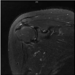 Fig.  9.  Shoulder  MRI,  T2  fat  suppression  image  of  case 3