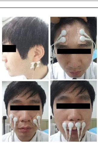 Fig. 1. The picture shows position of the surface EMG electrode (frontalis)은  이마를  올리는  동작,  협골근(zygomaticus) 은 뺨을 올리는 동작, 구륜근(orbicularis oris)은 입술을  ‘오-’ 하는 동작을 환자에게 연습시킨다