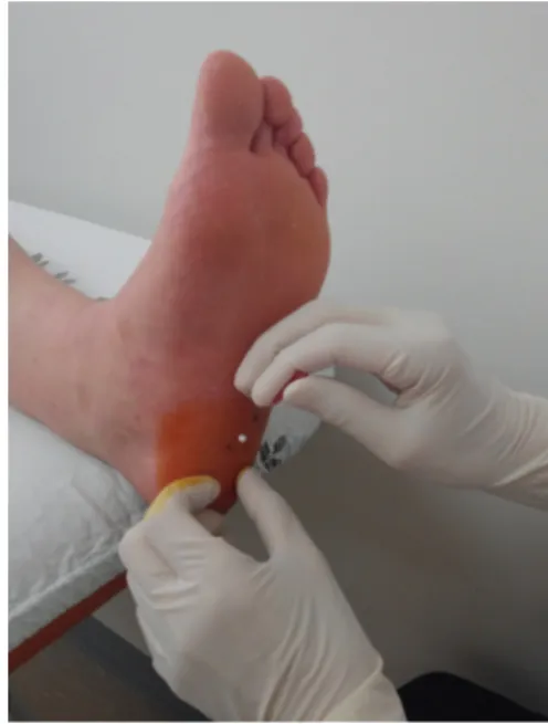 Fig. 1. Application of catgut-embedding acu- acu-puncture therapy on plantar fasciitis
