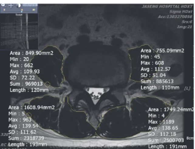 Fig.  1.  Cross-sectional  area  of  psoas  and  paraspinal  muscles  at  the  superior  part  of  L4  level measured on MRI