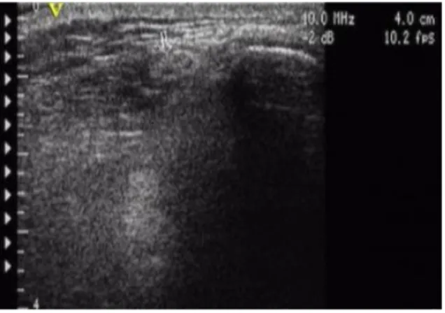 Fig.  1.  Measuring    depth  of  acupoint  by  ultrasonoscope  and  gauging  the  insertion  length