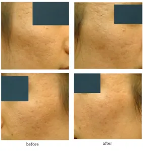 Fig.  5.  Case  3Fig.  4.  Case  2해  매우  만족하였으며  시술  시  통증이  불편했다고  응답하였다.3.  증례  31) 환자 선○○(29세/남)2) 주소증볼과  턱에  발생한  화농성  여드름  및  ice  pick, boxcar  형태가  혼재되어  있는  여드름  흉터3) 발병일2002년경  여드름  발생  후  흉터  남음 4) 추정유발인자 무분별한  여드름  압출 5) 과거력 별무 6) 현병력 별무 7)진찰 내용