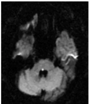 Fig.  1.  Diffussion-weighted  brain  MRI  ima-  ge  showing  acute  right  pontine  infarction  (PPRF  lesion)  (2011