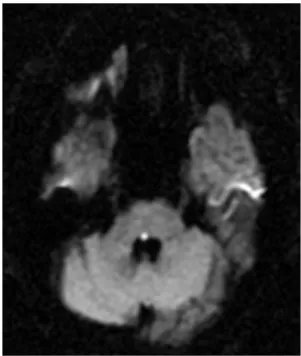 Fig.  2.  Diffusion-weighted  brain  MRI  ima-  ge  showing  acute  left  medulla  oblongata  infarction(2011