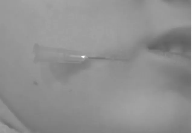Fig  2.  Insertion  of  the  Needle  into  the  Dermis에  활용되는  시술로서,  subcision의  효과는  피하지방층의  섬유성  격막을  끊는  상처자극을  통해,  그  부위에 출혈을  유도하여  콜라겐  등  새로운  결합조직이  생성되도록  유도하는  상처치유작용을  일으켜  꺼진  부위의 융기가  가능해지도록  하는  방법이다39,40)