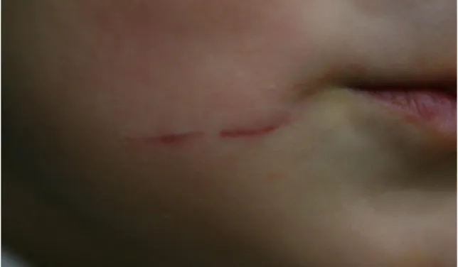 Fig  3.  A  red  linear  trace  by  dermal  subcision 
