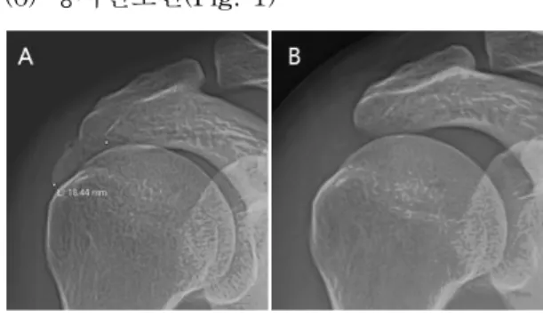 Fig.  1.  Rt.  shoulder  X-ray  AP  view  of  case  1 