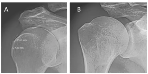 Fig.  3.  Rt.  shoulder  X-ray  AP  view  of  case  2 증  소실.  외전  40˚,  굴곡  90˚.  타  병원에  검진  예약이  되어  있어  외출하느라  통증  제어를  위해 NSAID  주사