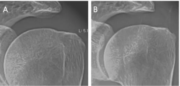 Fig.  4.  Lt.  shoulder  X-ray  AP  view  of  case  3