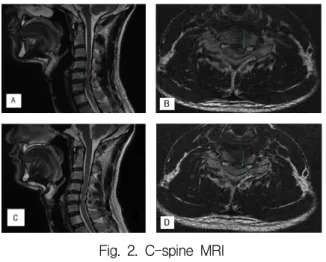 Fig.  1.  C-spine  X-ray(11.02.07) A  :  lateral  view  of    C-spine. 