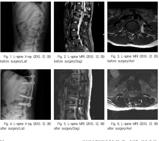 Fig.  1.  L-spine  X-ray  (2010.  12.  05)  before  surgery(Lat)