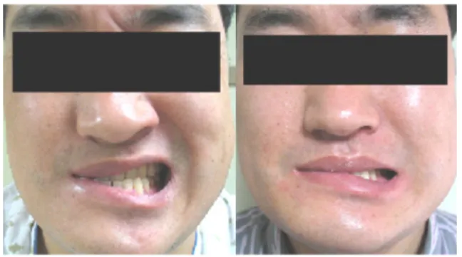 Fig  3.  Before  and  after  pictures  of  46  years  old  patient