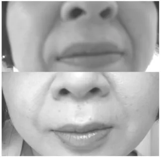 Fig.  1.  Patient  1  :  57  years  old  female  Pictures  before  and  after  needle-embedding  therapy