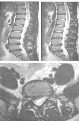 Fig. 2. T 2 weighted sagittal and axial view of Case 1 심○○, Level L 5 ～S 1 .시작자세로 되돌린다.⑤ 무릎을 머리로부터 멀리 민다