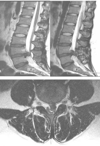 Fig. 3. T 2 weighted sagittal and axial view of Case 2 김○○, Level L 4 ～ 5.중 2008년 8월 16일 local 재활의학과 근전도검사상HIVD L5～S1Dx