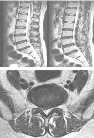 Fig. 5. T 2 weighted sagittal and axial view of Case 4