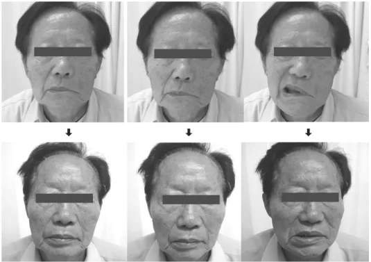 Fig.  1.  Patient  #1  with  Lt.  facial  palsy
