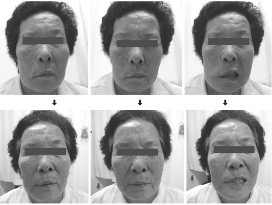 Fig.  2.  Patient  #2  with  Rt.  facial  palsy