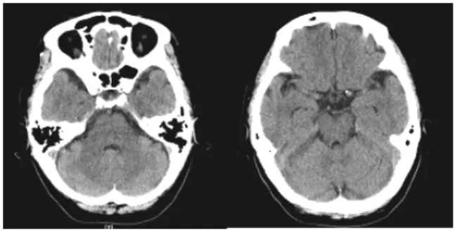 Fig.  3.  Brain  CT  of  patient  #3