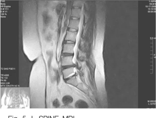 Fig.  3.  L-SPINE  MRI T2,  sagittal  view(2008.  9.  9).