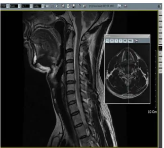 Fig.  2.  Protruded  disc Central  disc  protrusion  at  C5/6.