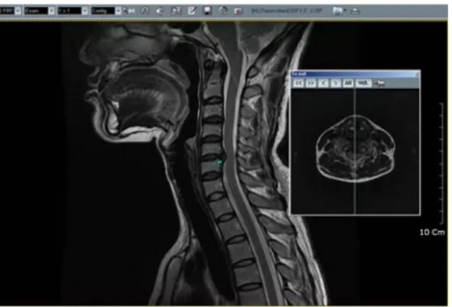 Fig.  3.  Extruded  disc