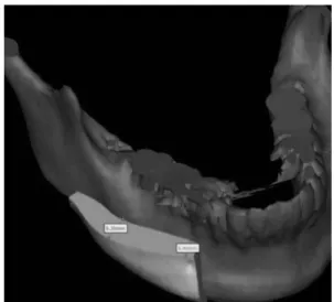 Fig. 3. Reconstructed virtual skull based on DICOM file from  computerized tomography (Case 2).