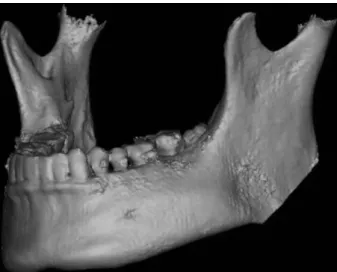 Fig. 6. Mandibular contouring was performed as planned in virtu- virtu-al surgery. Reduction was performed successfully by using  surgi-cal guide