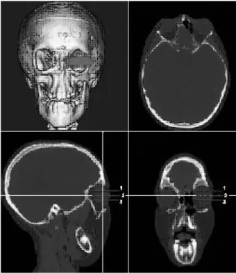 Fig. 5. Selection of Line 2 and Line 1 for division of eyeball.