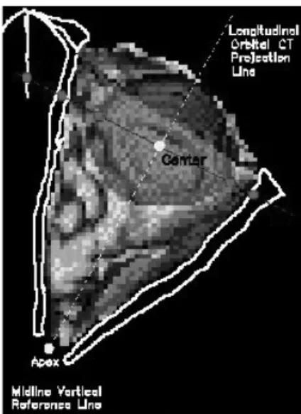Fig. 7. Selection of Line 2 and Line 1 for division of eyeball.
