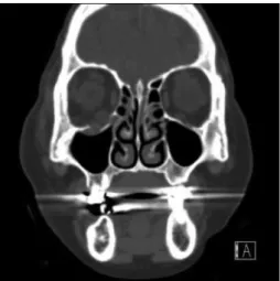 Fig. 3. Postoperative CT coronal image.