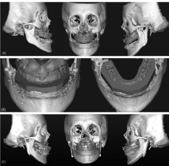 Fig. 2. Virtual model surgery procedure and wafer fabrication. (A)  Repositioning of the maxilla according to the STO in a 3D virtual  skull