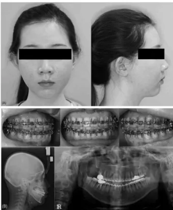 Fig. 3. Afterorthognathic surgery, mandibular prognathism and  apertognathia were corrected