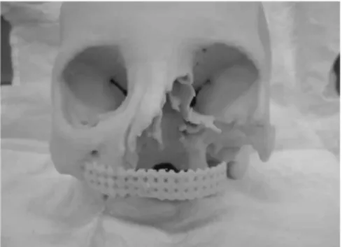 Fig. 3. Simulation of the maxillary reconstruction with 3-D rapid  prototype and baseplate wax.