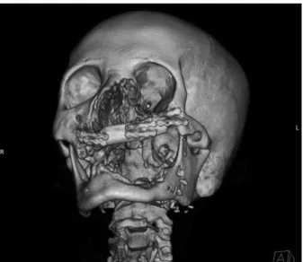 Fig. 9. Radiograph after implants placement. A total of 14 im- im-plants have been placed.
