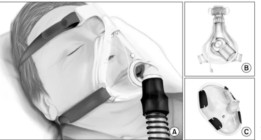 Figure  3.  Noninvasive  ventilation.  (A,  B)  Oro-nasal  masks.  (C)  Full-face  masks.