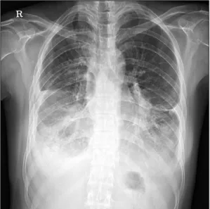 Figure  1.  Plain  chest  X-ray  of  Case  1  at  the  time  of  simulation  for  palliative  radiotherapy.병상에서 누워만 있는 환자들도 이완요법이 도움될 수 있다는 보고가 있다