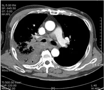 Figure 2. Simple  X-ray  finding  of  case  A.  Except  for  mild  cardio- cardio-megaly,  no  active  primary  or  metastatic  lung  lesions  were  noted.