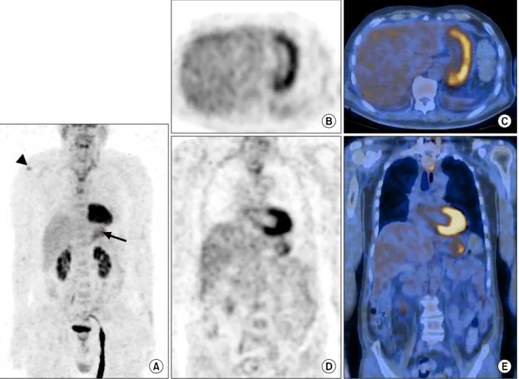 Figure  4.  PET/CT  was  performed  after  surgery.  Maximum  intensity  projection  (MIP)  image  (A)  showed    there  were  hypermetabolic  foci  around  right  shoulder  (arrow  head)  and  stomach  (black  arrow)