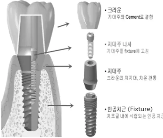 Fig.  1  The  example  for  dental  implant  abutment  fracture  by  screw  loosening 