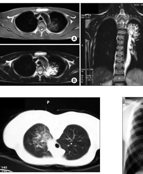 Figure  2.  MRI  showed  re- re-ticular  shaped  iso-signal  intensity  of  T1WI  (A)  and  mottled  reticular  shaped  high  signal  intensity  on  T2WI  (B)
