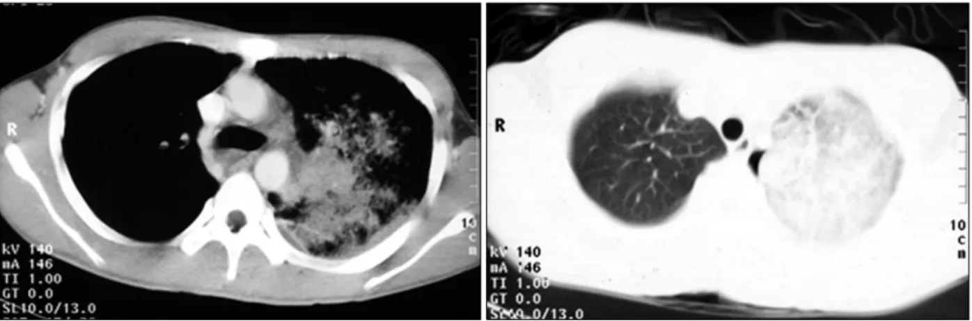 Figure  5.  CT  showed  ill-defined  air  space  consolidation  in  LUL.  CT:  computer  tomography;  LUL:  left  upper  lobe.