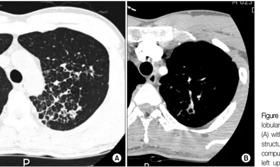 Figure 8. CT showed inter- inter-lobular  septal  thickening  (A) with enhanced vascular structure  (B)  in  LUL