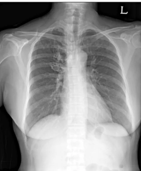 Figure  1.  Initial  simple  chest  X-ray  film  shows  bron- bron-chiectasis  on  right  upper  lung  field  and  suspicious   peri-bronchial  infiltrations  on  both  lower  lung  fields.