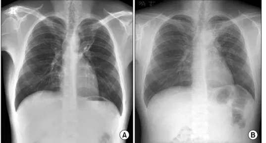 Figure 1. (A) Chest PA was  performed  8  monthe  ago. 